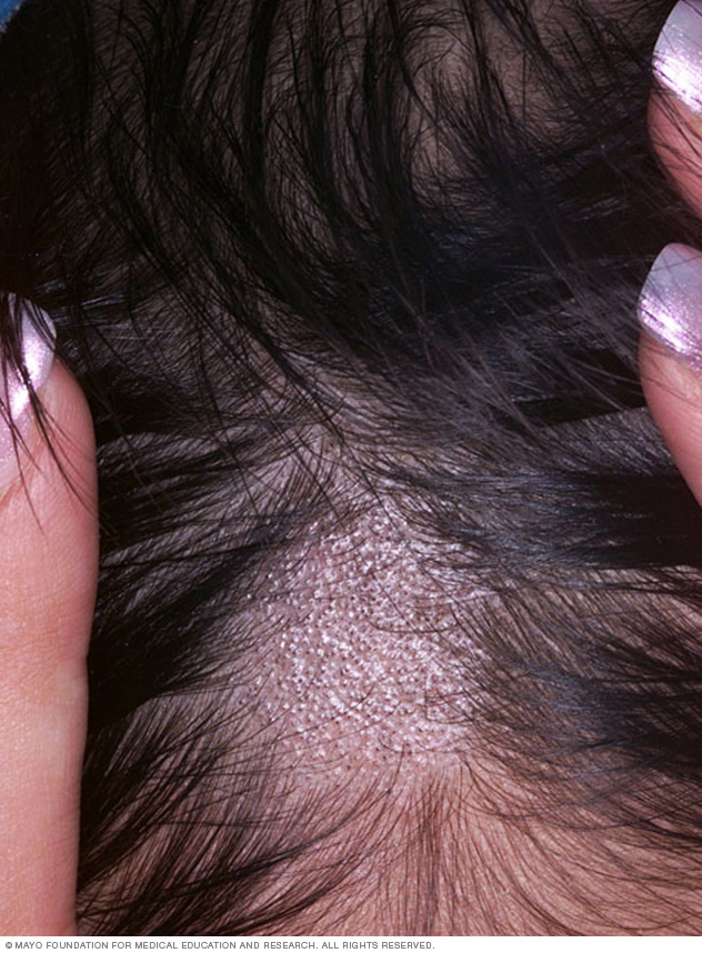 Close-up image of ringworm of the scalp